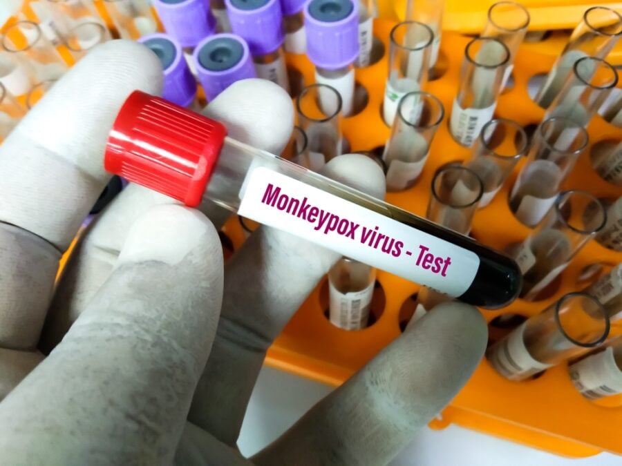 Gloved hand holding a "Monkeypox virus - Test" blood sample vial.