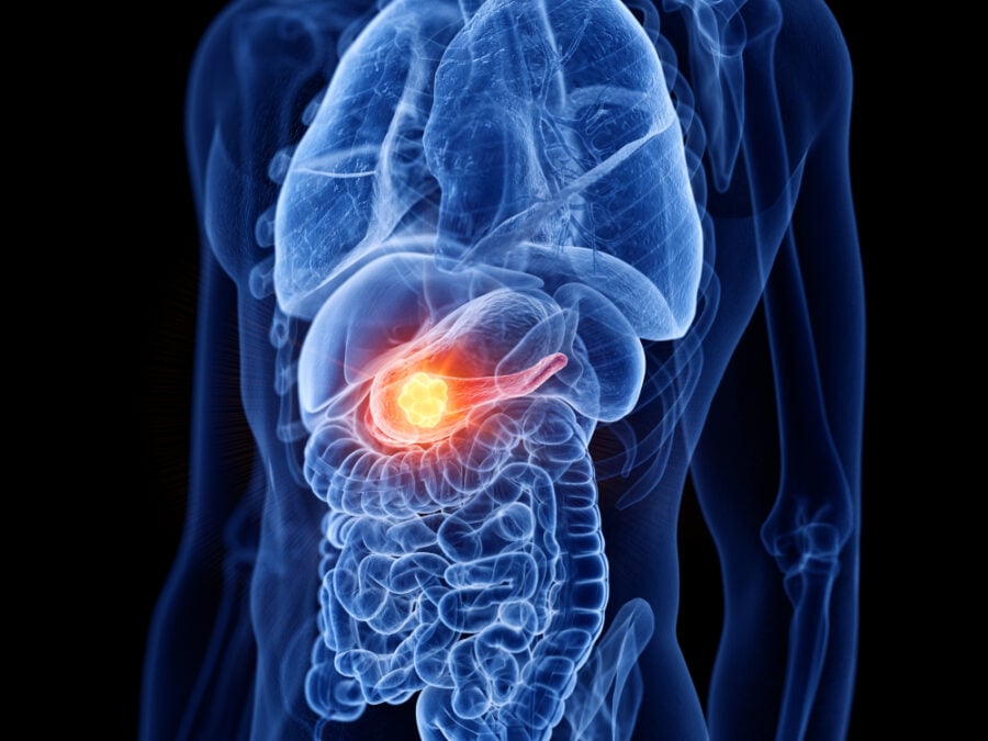 Anatomical model showing pancreas with tumor.